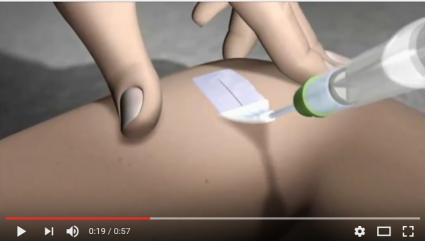 Adhesys Medical Wundkleber Youtube Videoscreen